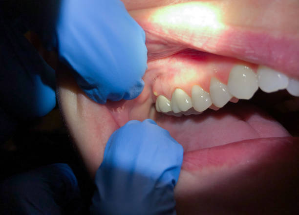 Best Emergency Dental Care for Abscessed Tooth in Van Alstyne, TX