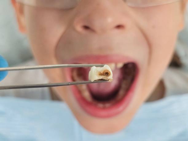 Best Emergency Root Canal Treatment in Van Alstyne, TX